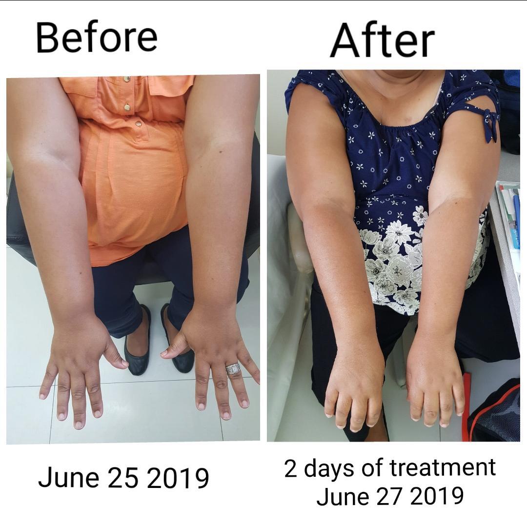 Lymphedema before and after_Jody K